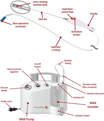 Use of a neuro-evacuation device for the endoscopic removal of third ventricle colloid cysts